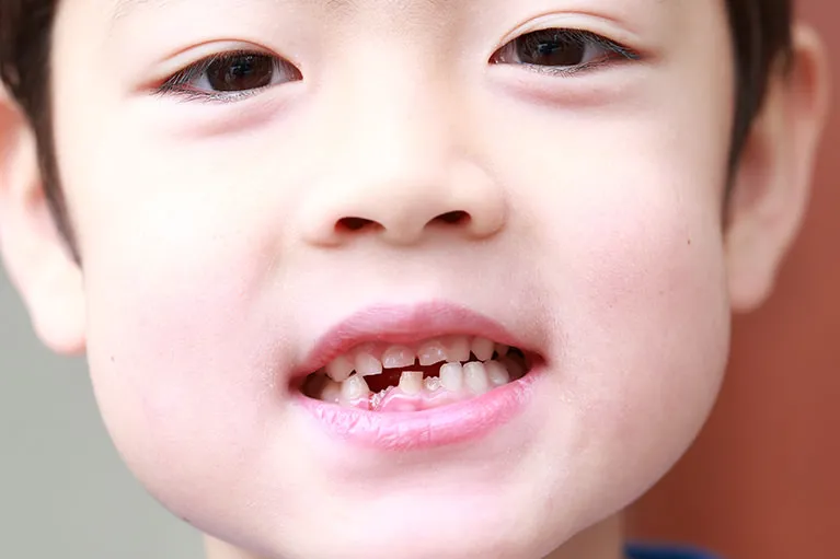 ママ・パパ必見!お子様の矯正治療が大切な理由